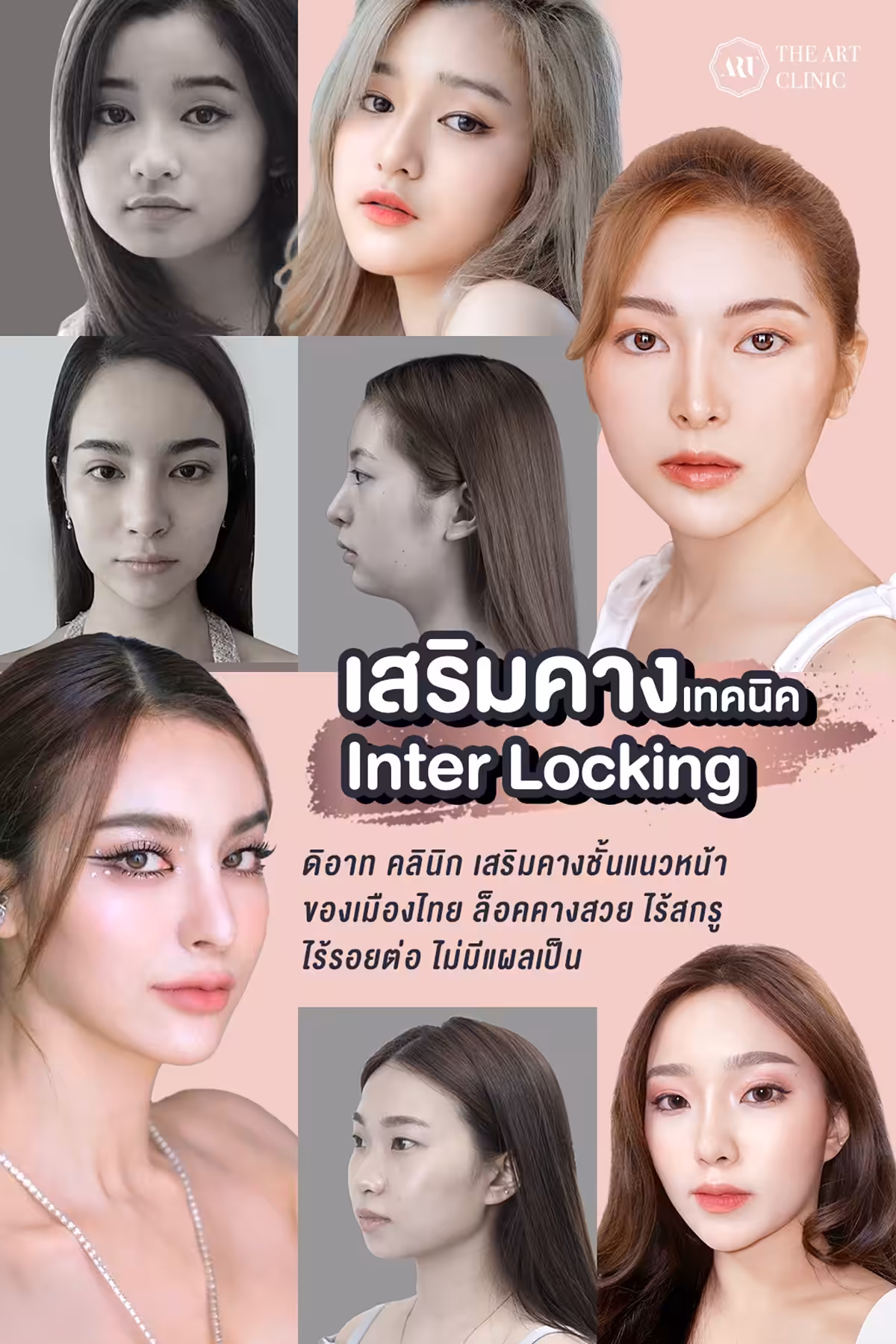 เสริมคาง เทคนิค Interlocking