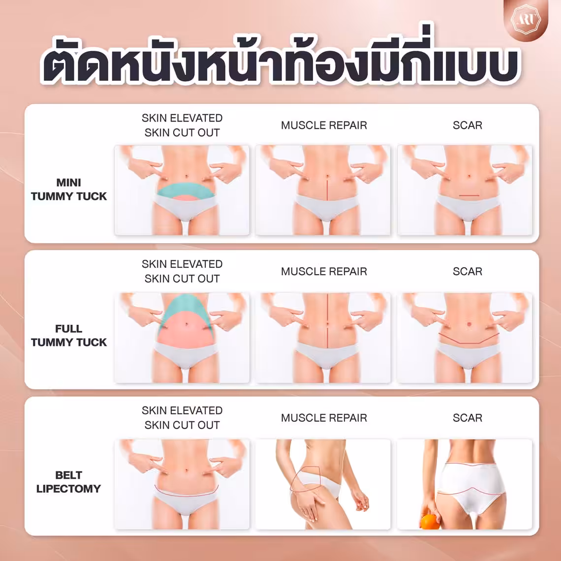 ตัดหนังหน้าท้องมีกี่แบบ