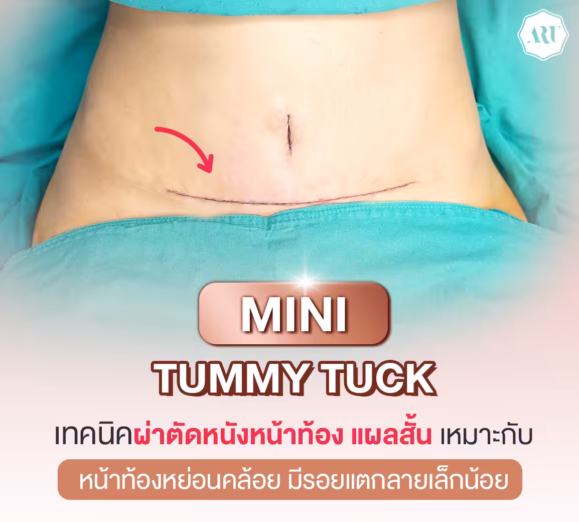 ตัดหนังหน้าท้องแบบ Mini Tummy Tuck