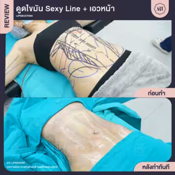 ดูดไขมัน Sexyline