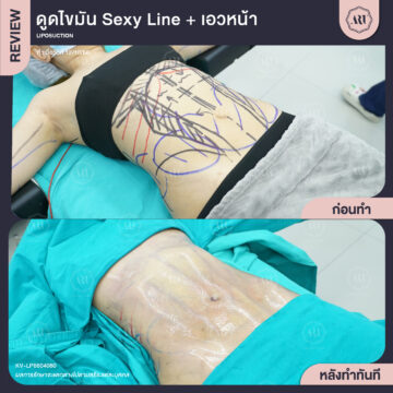 ดูดไขมัน Sexyline