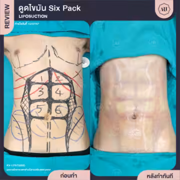 ดูดไขมัน Sixpack