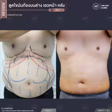 ดูดไขมันหน้าท้อง และดูดไขมันเอวเอส