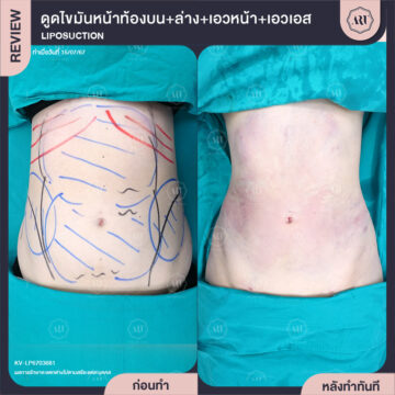 ดูดไขมัน Sexyline