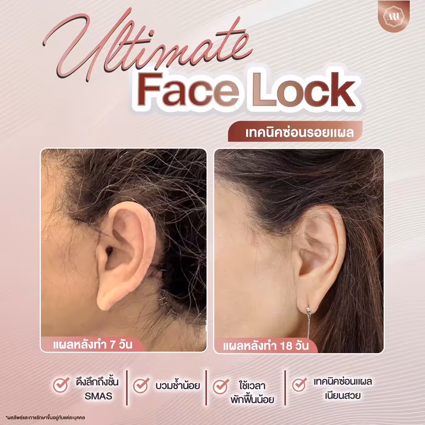 ดึงหน้า Ultimate Face Lock เทคนิคซ่อนรอยแผล