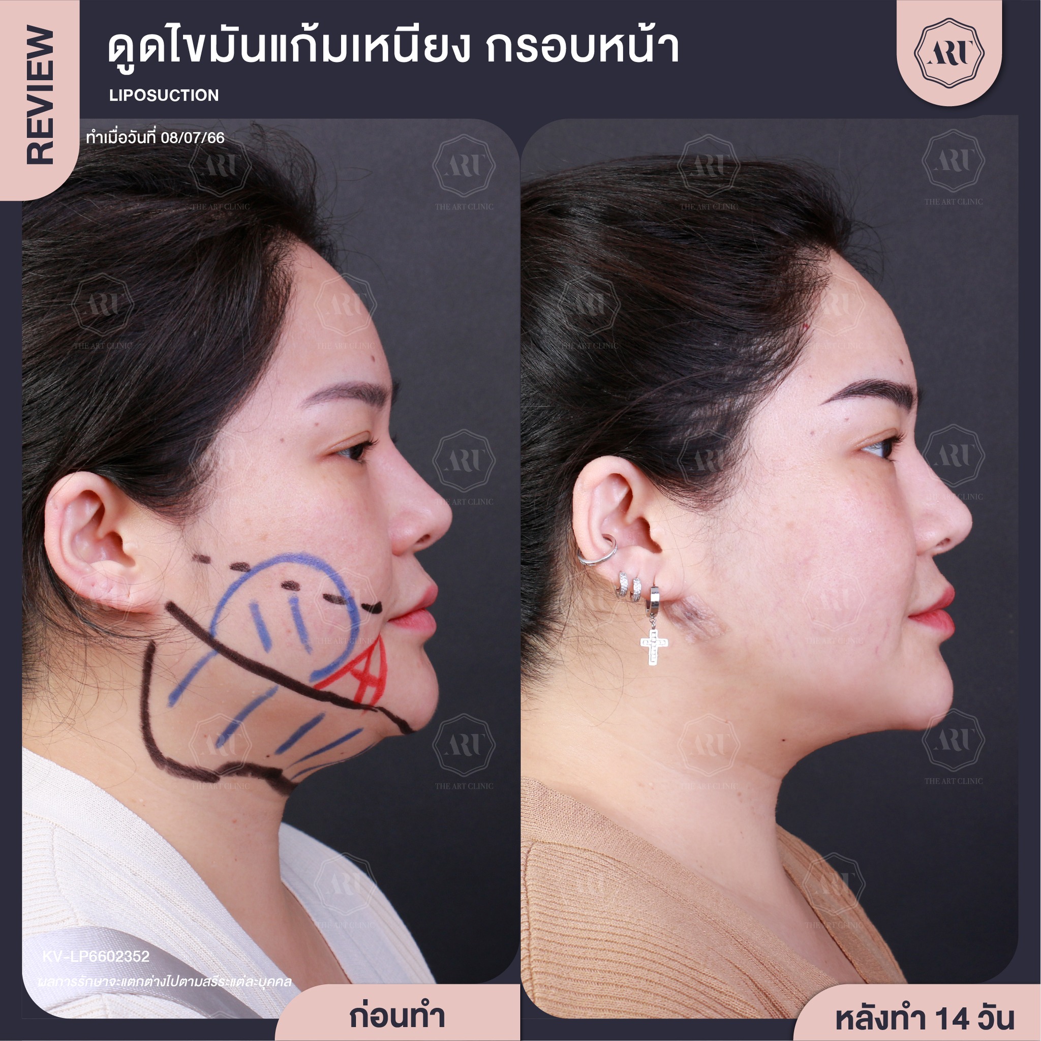 ดูดไขมันหน้า เหนียง