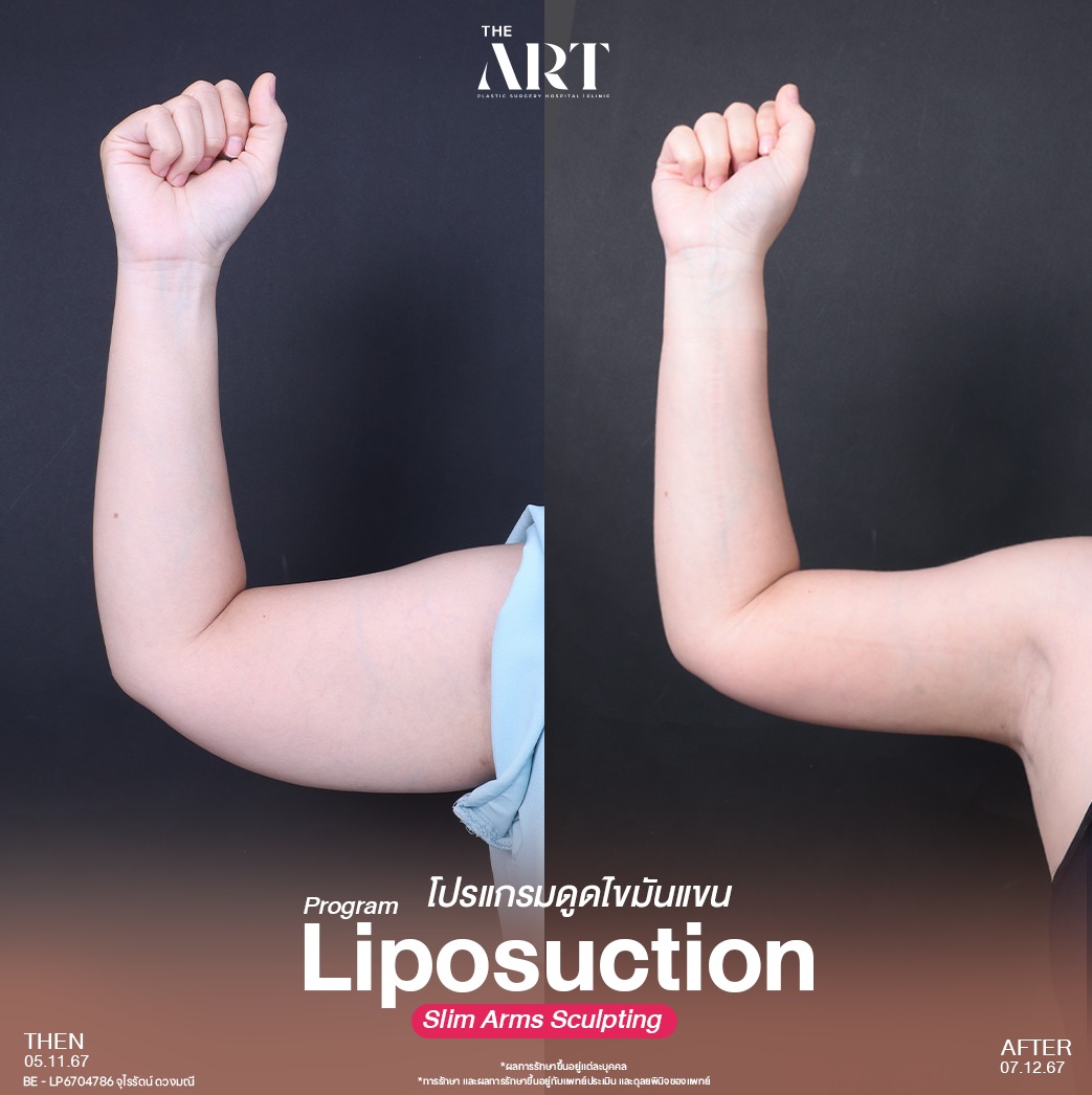 ดูดไขมันแขน