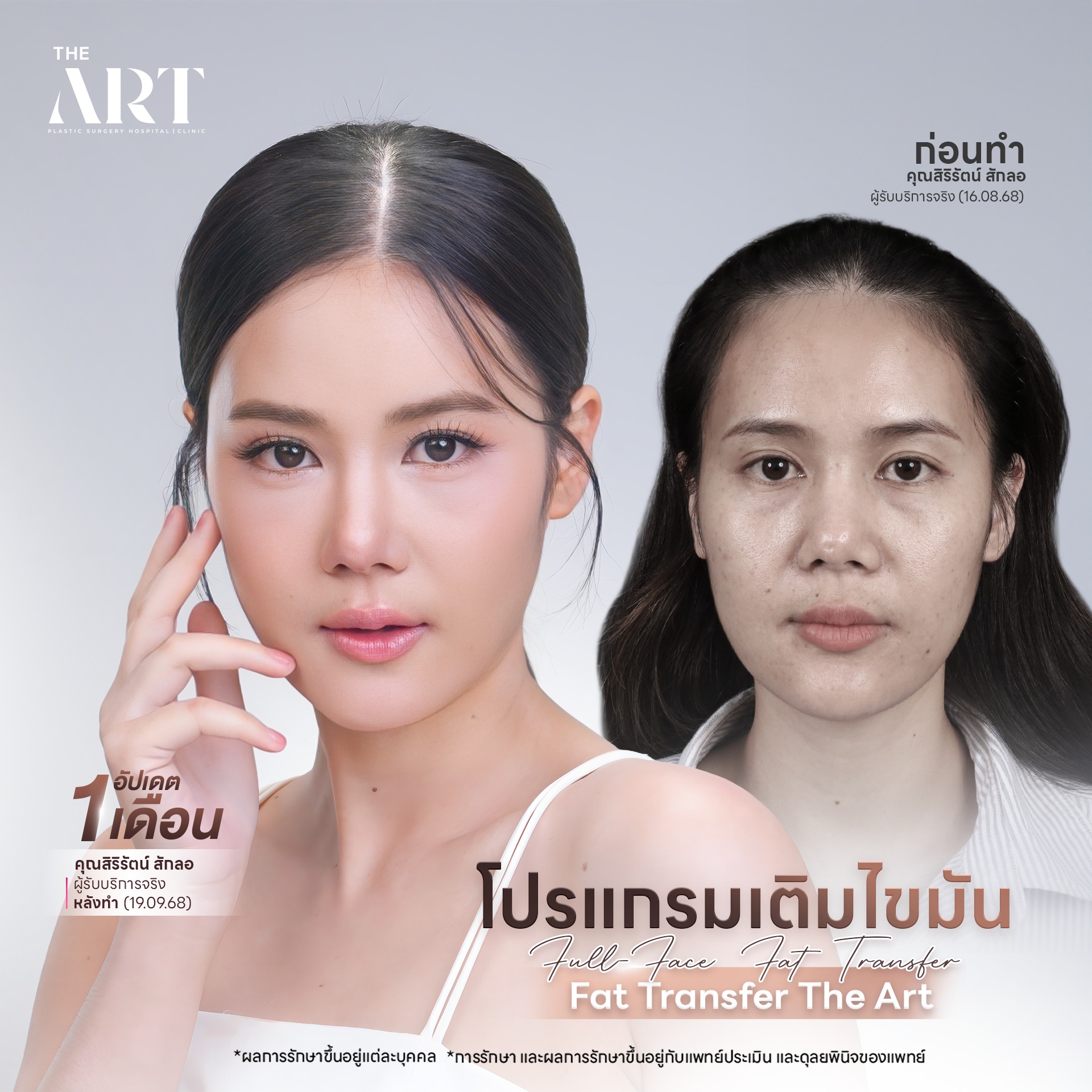 เติมไขมันหน้า