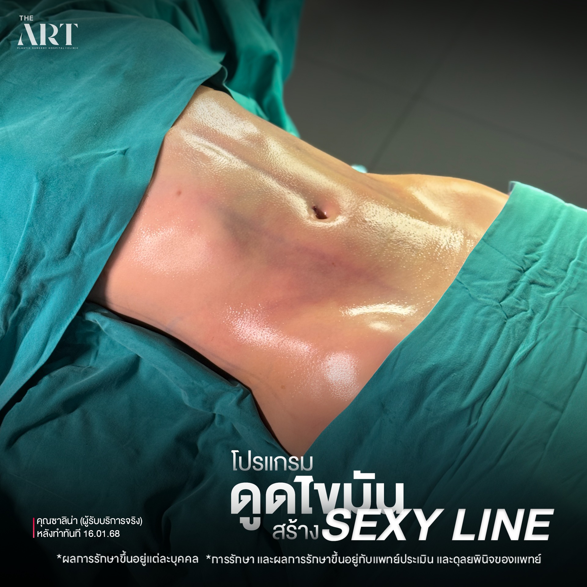 ดูดไขมัน Sexyline