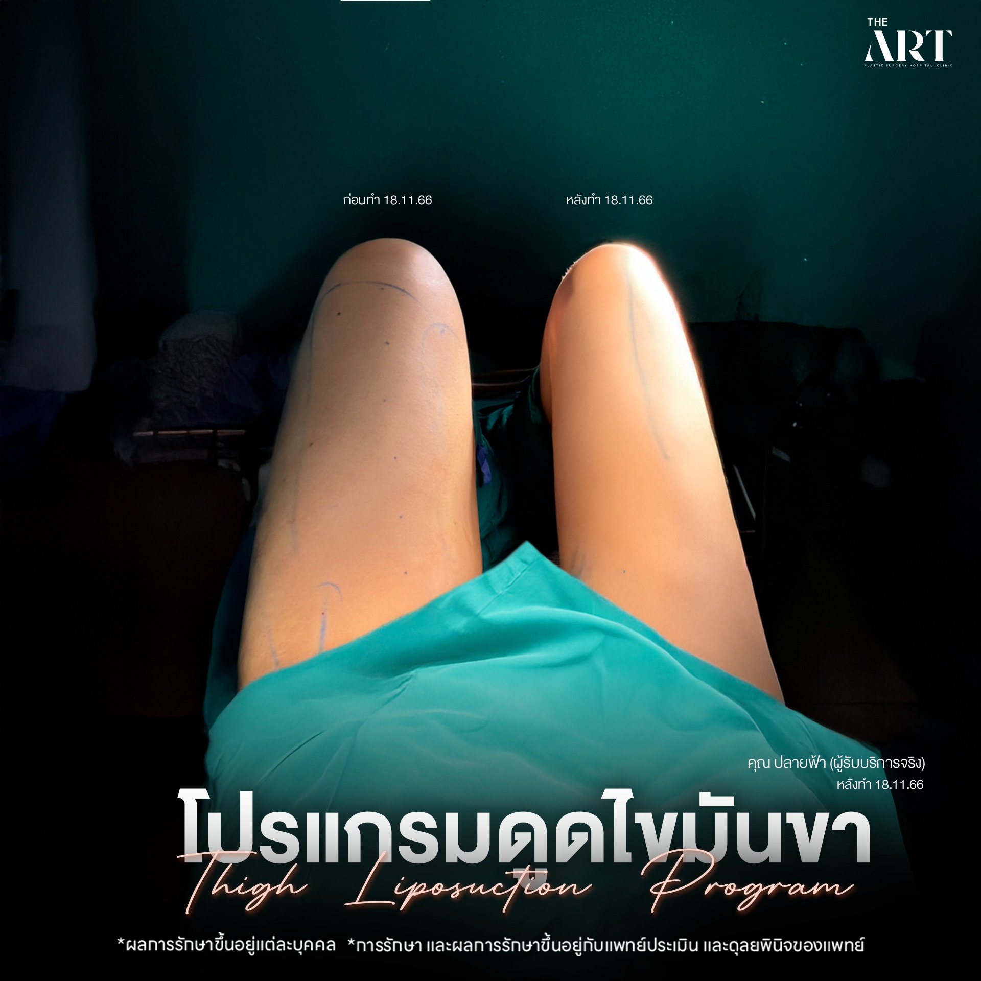 ดูดไขมันขา