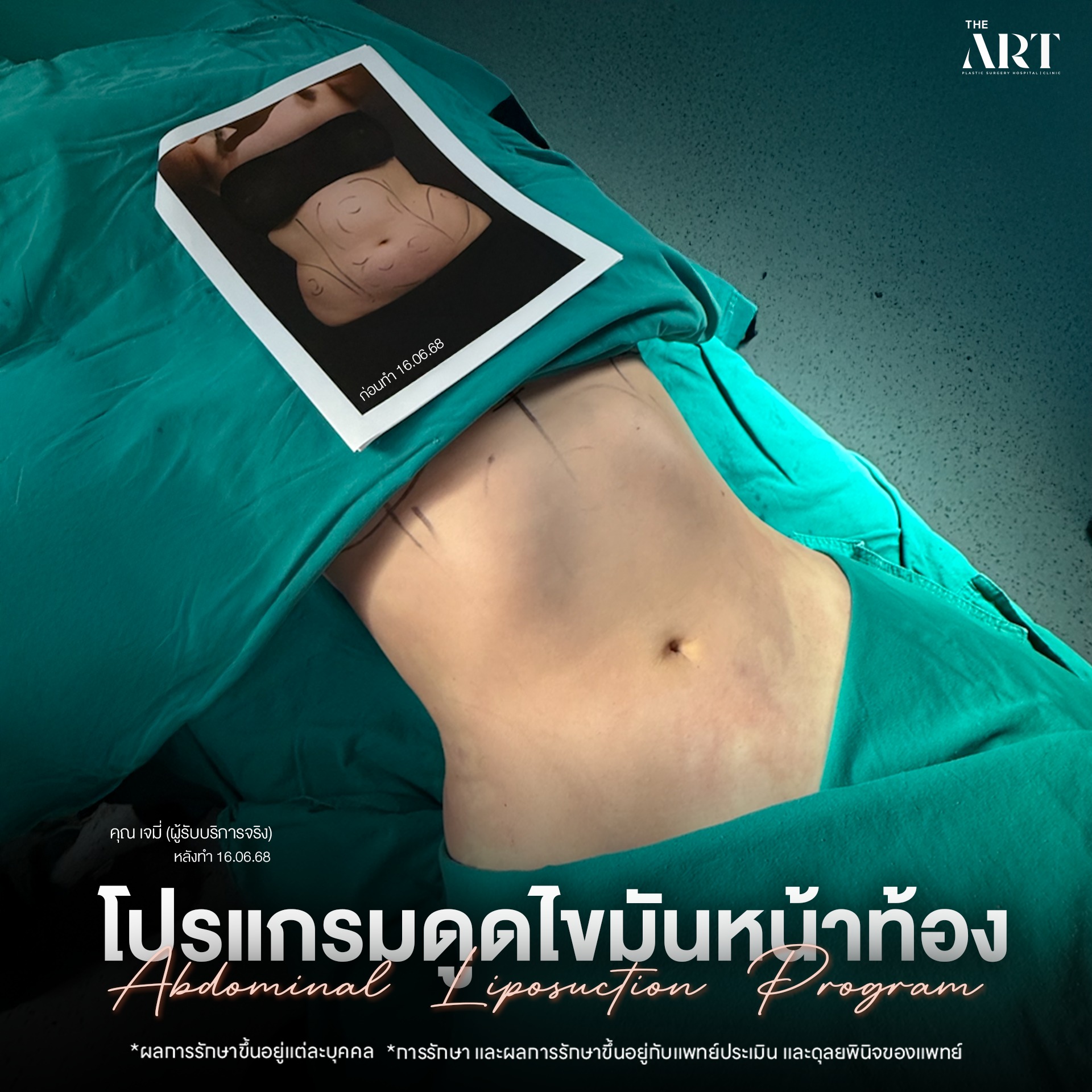 ดูดไขมันหน้าท้อง