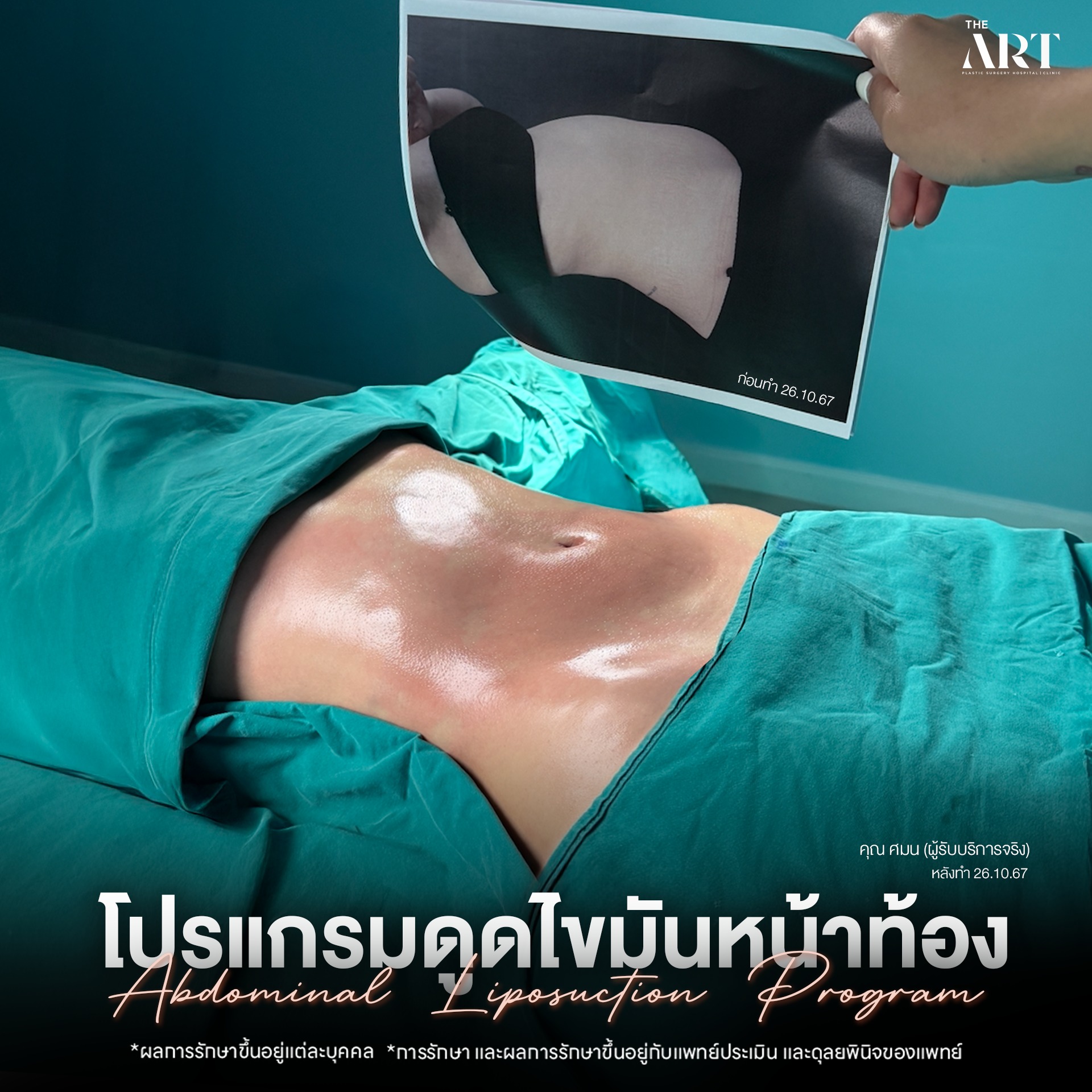 ดูดไขมันหน้าท้อง