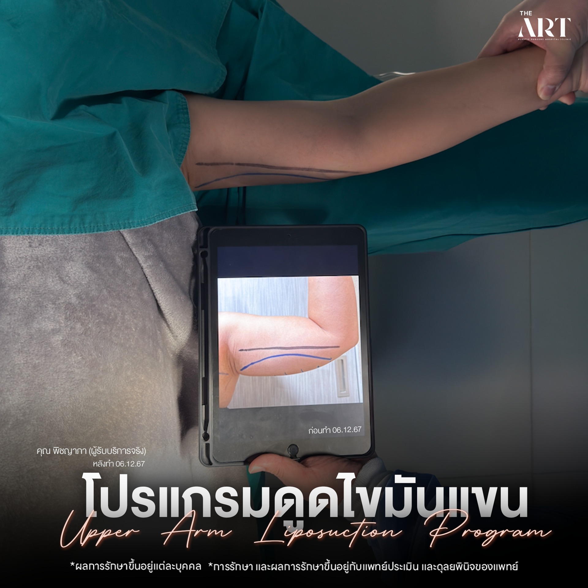 ดูดไขมันแขน