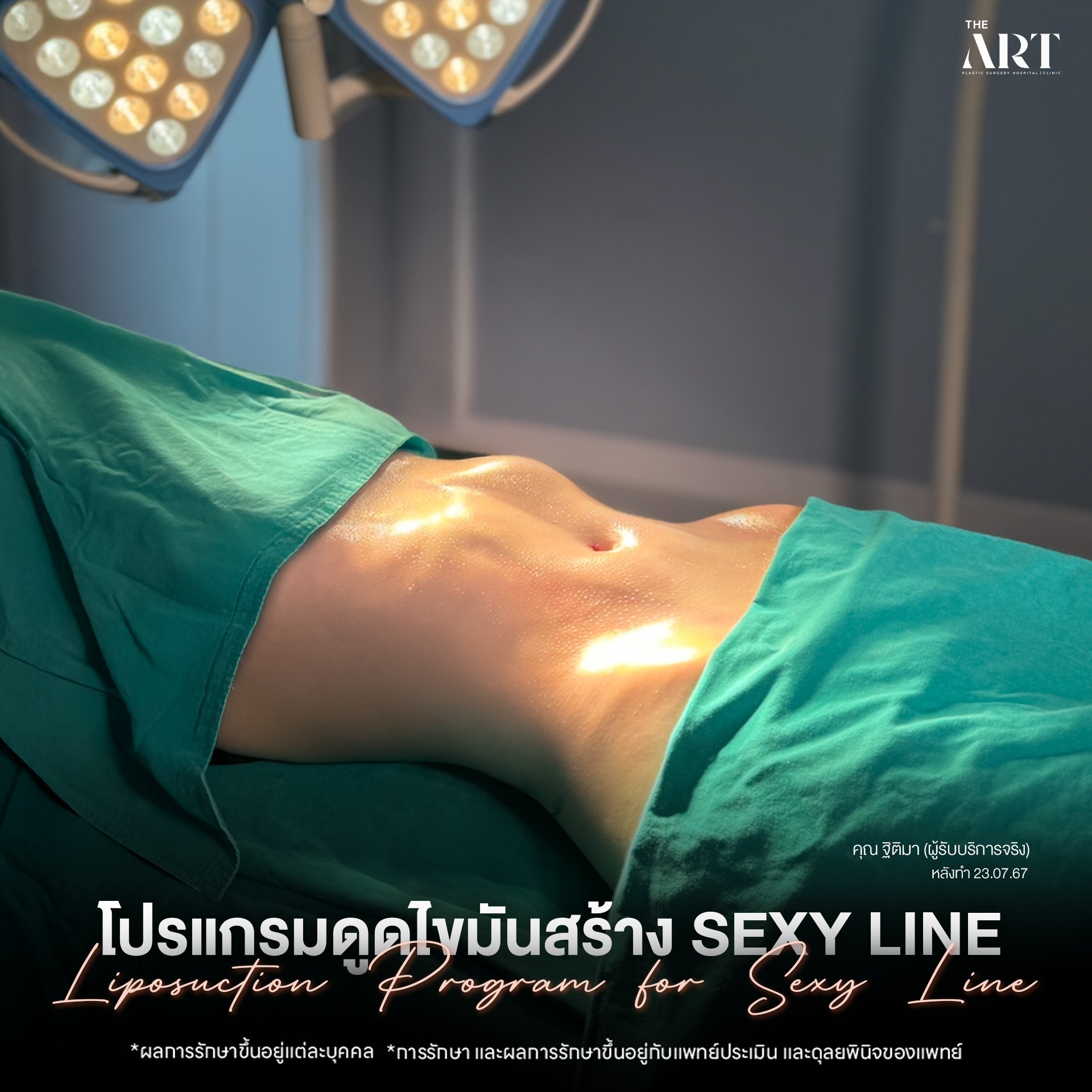 ดูดไขมัน Sexyline