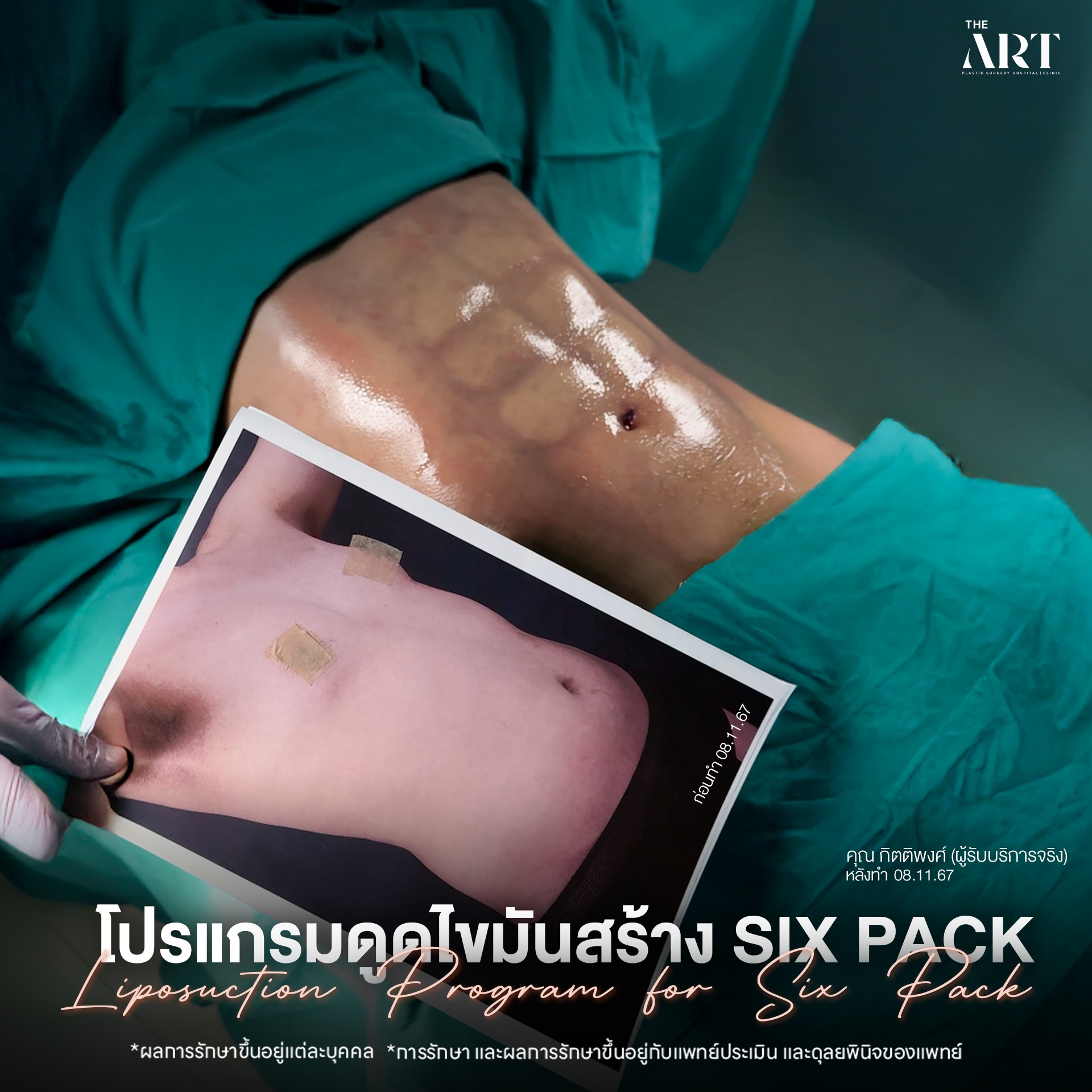 ดูดไขมัน Sixpack