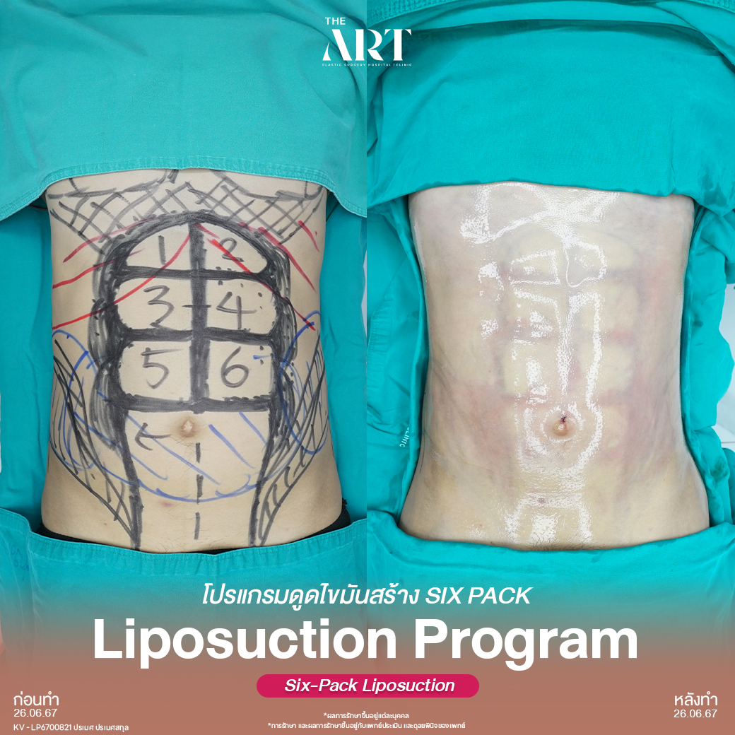 ดูดไขมัน Sixpack