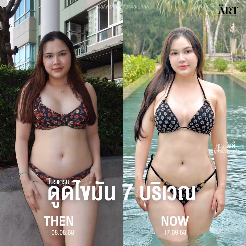 รีวิว ดูดไขมัน ดิอาท
