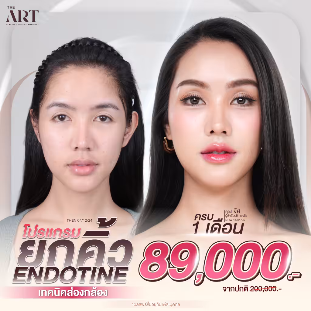 Promotion ยกคิ้ว Endotine 89,000