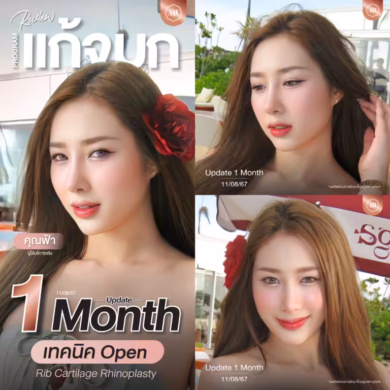 Dr.Bill LP6603163 แก้จมูก open ซี่โครง อัจจิมา พังสอาด-04