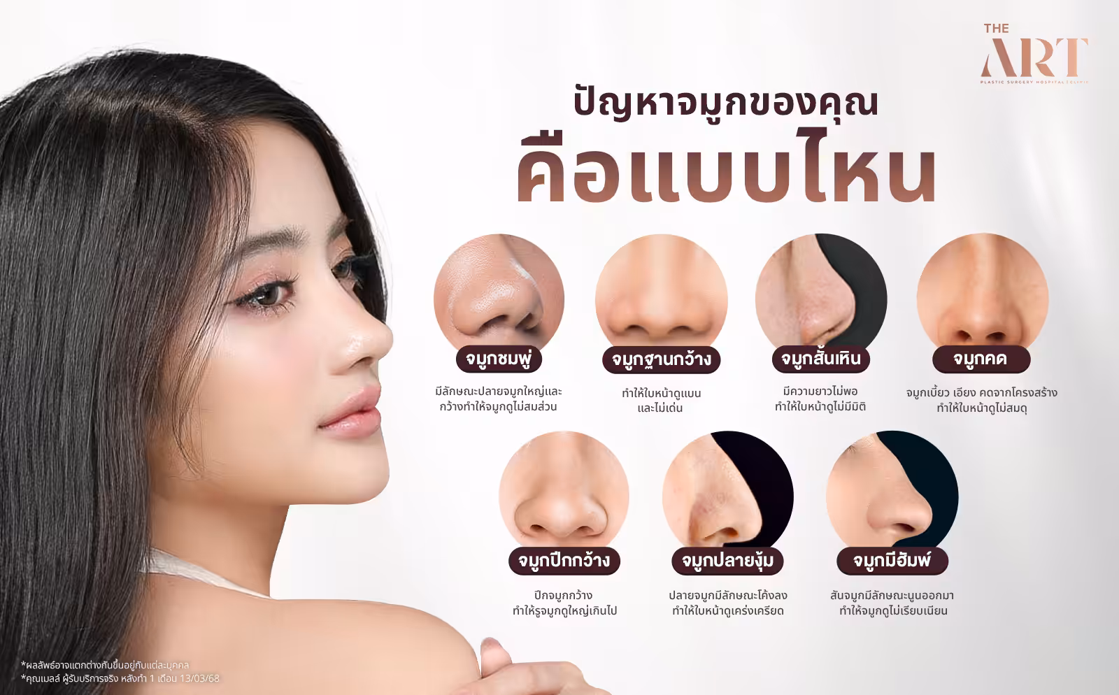 ปัญหาจมูกของคุณคือแบบไหน ภาพรวม 7 ลักษณะจมูกที่พบบ่อย พร้อมวิธีสังเกต: จมูกชมพู่ ปีกกว้าง ฐานกว้าง สันเป็นคลื่น จมูกคด ปลายจมูกหุบ และจมูกไม่มีสัน สำหรับผู้ที่สนใจศัลยกรรมจมูก แก้ไขทรงจมูกให้รับกับใบหน้า