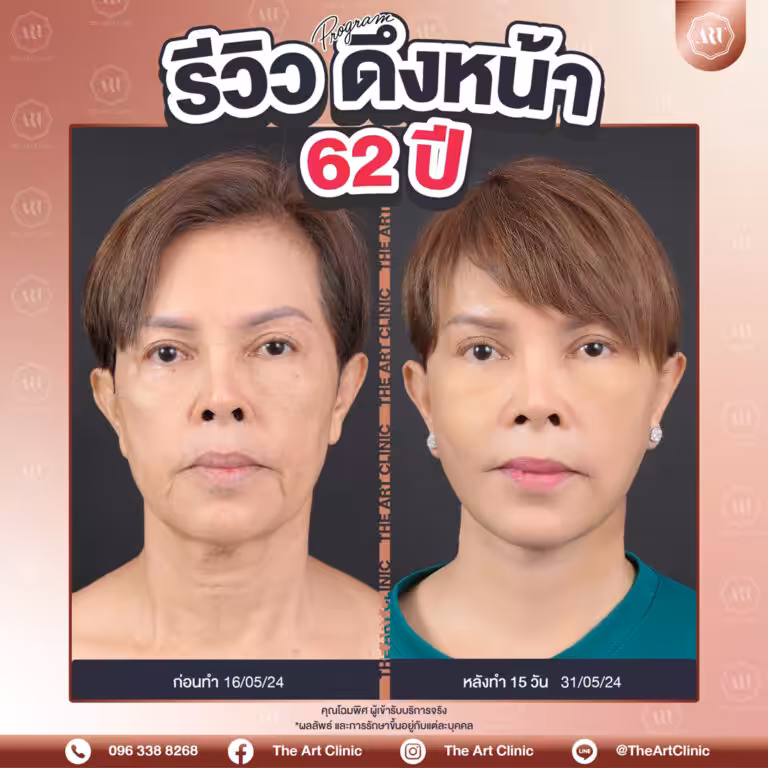 รีวิวดึงหน้า-Face-Lift-11