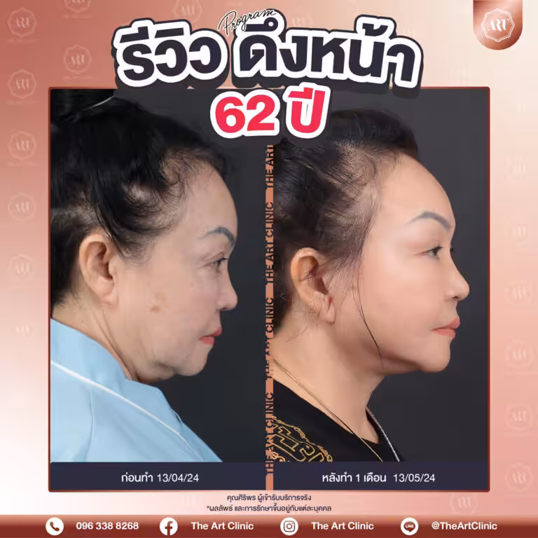 รีวิวดึงหน้า-Face-Lift-14