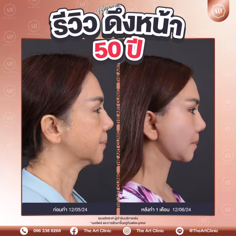 รีวิวดึงหน้า-Face-Lift-16