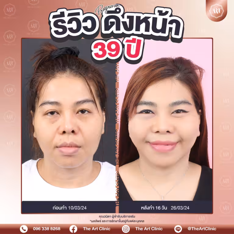 รีวิวดึงหน้า-Face-Lift-17