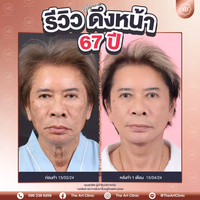 รีวิวดึงหน้า-Face-Lift-18