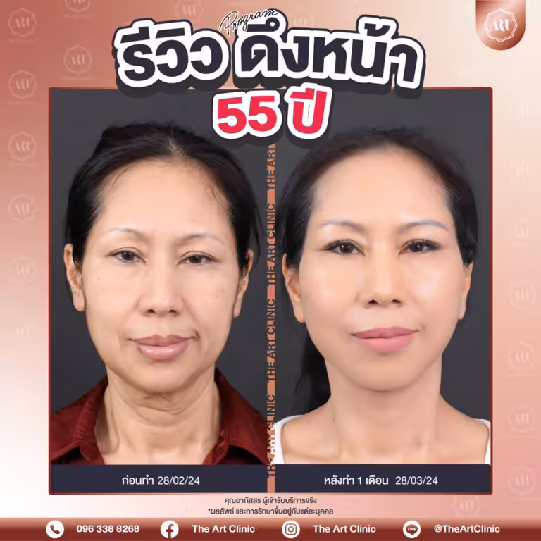 รีวิวดึงหน้า-Face-Lift-2