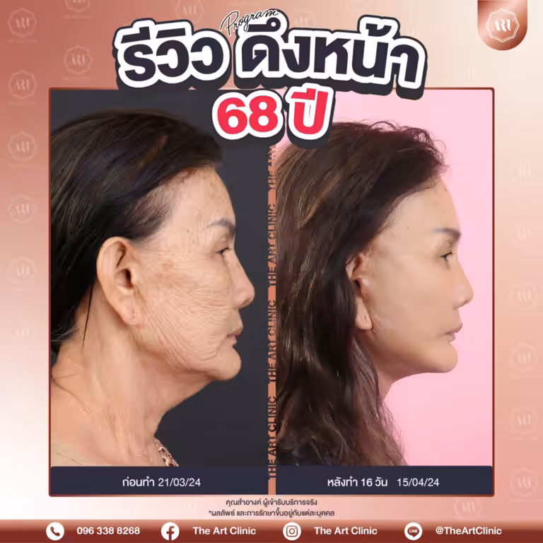 รีวิวดึงหน้า-Face-Lift-20