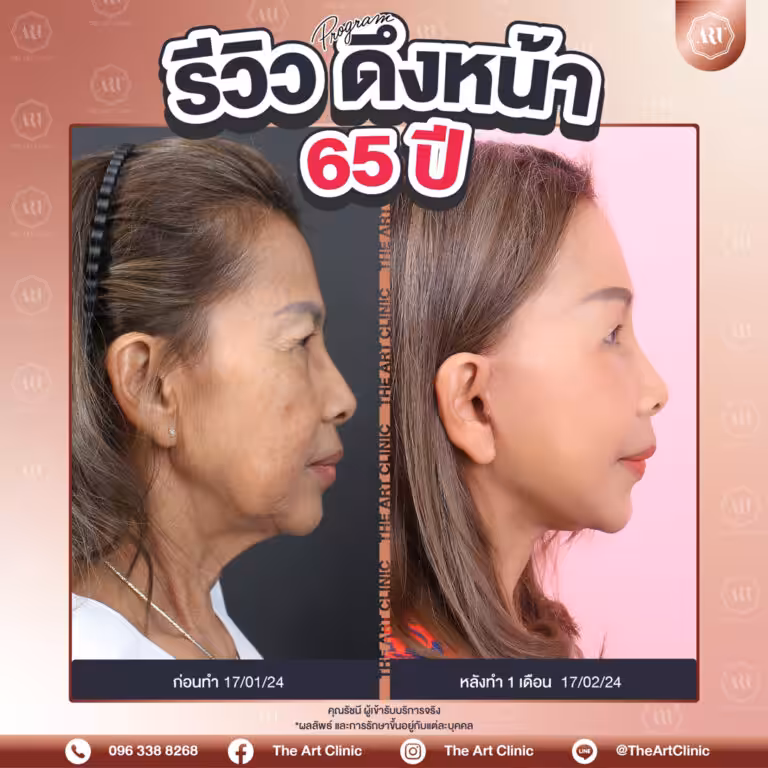 รีวิวดึงหน้า-Face-Lift-21
