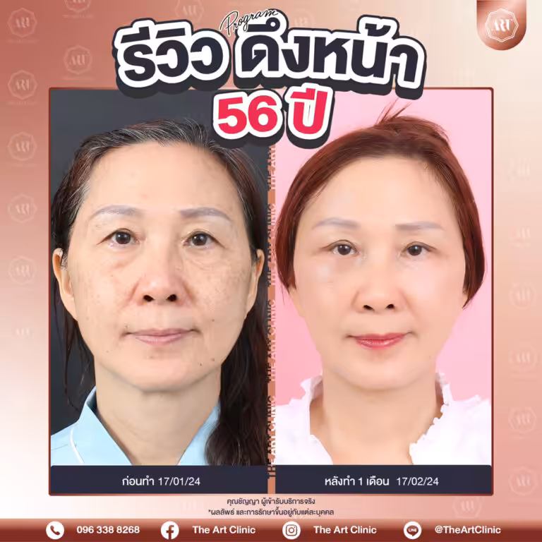รีวิวดึงหน้า-Face-Lift-22