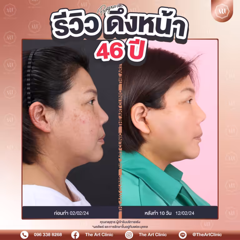 รีวิวดึงหน้า-Face-Lift-3