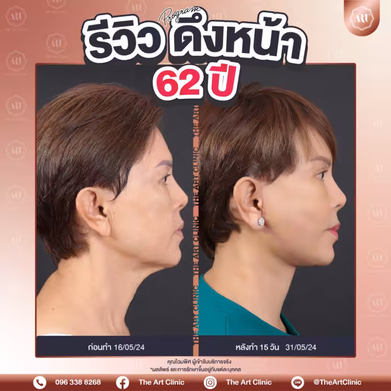 รีวิวดึงหน้า-Face-Lift-31
