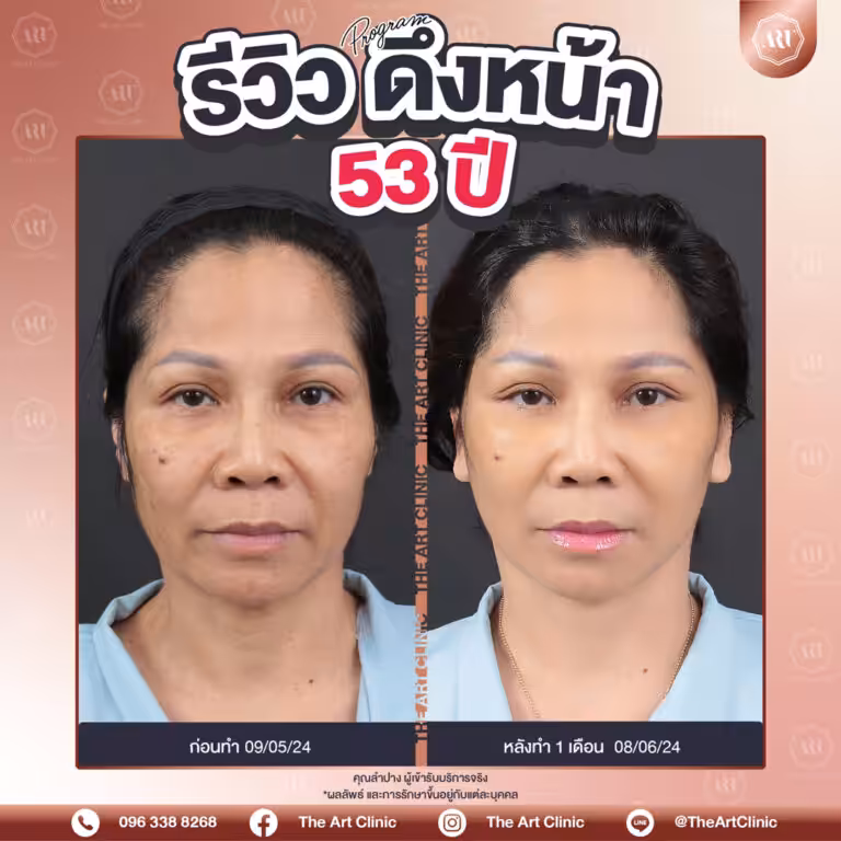 รีวิวดึงหน้า-Face-Lift-32