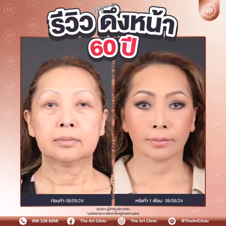 รีวิวดึงหน้า-Face-Lift-34