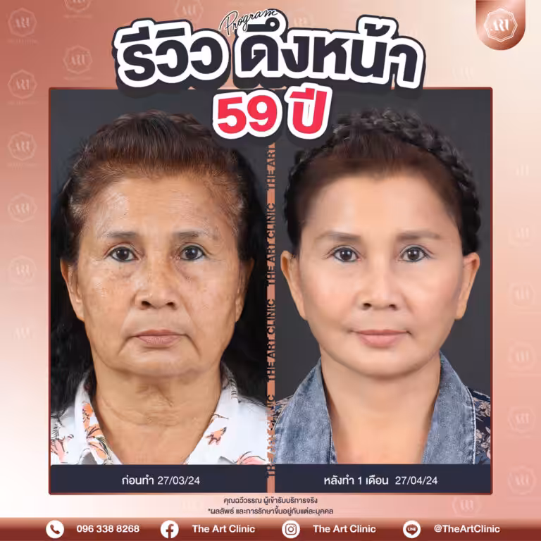 รีวิวดึงหน้า-Face-Lift-36