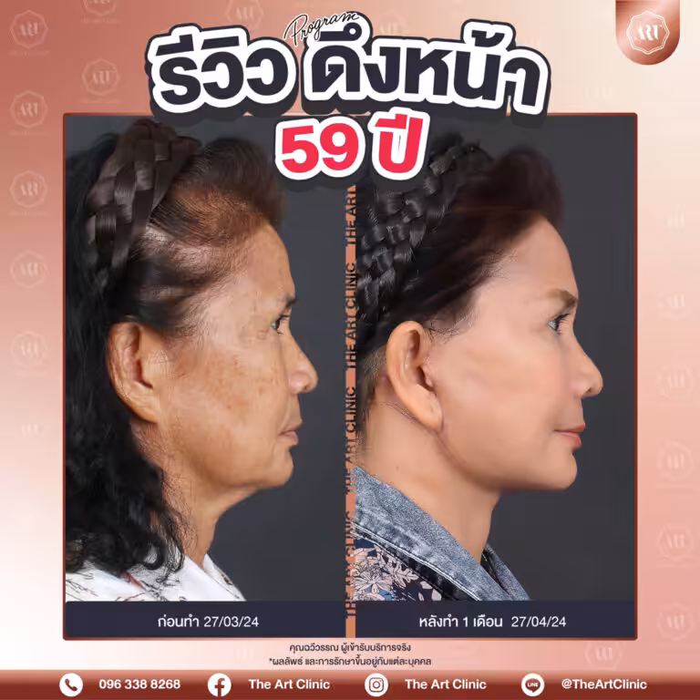 รีวิวดึงหน้า-Face-Lift-39