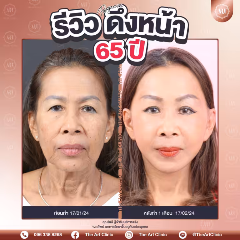รีวิวดึงหน้า-Face-Lift-41