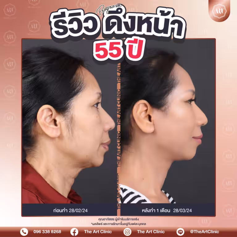 รีวิวดึงหน้า-Face-Lift-44