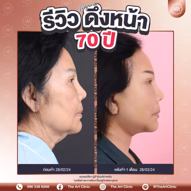รีวิวดึงหน้า-Face-Lift-45