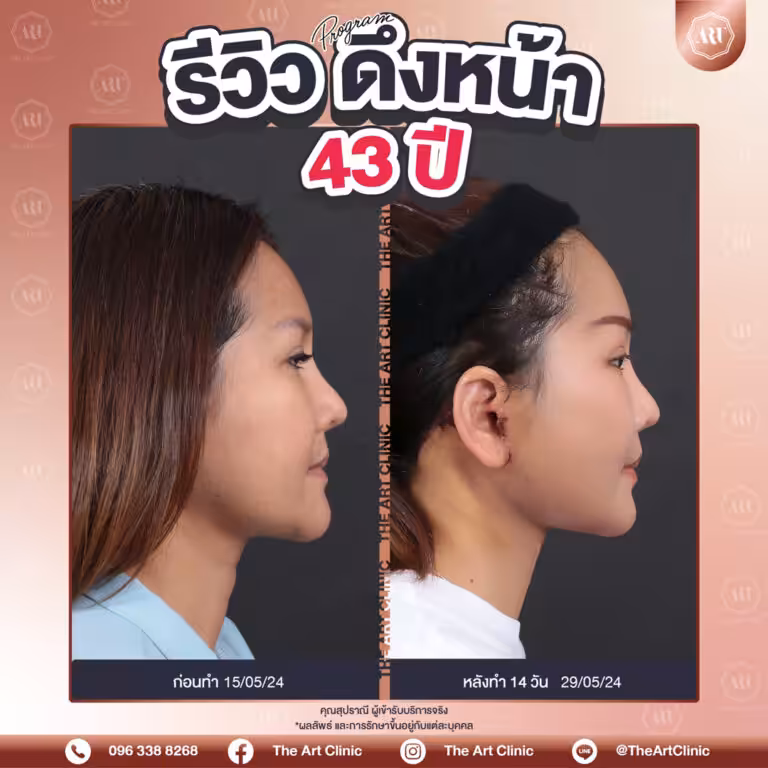 รีวิวดึงหน้า-Face-Lift-6