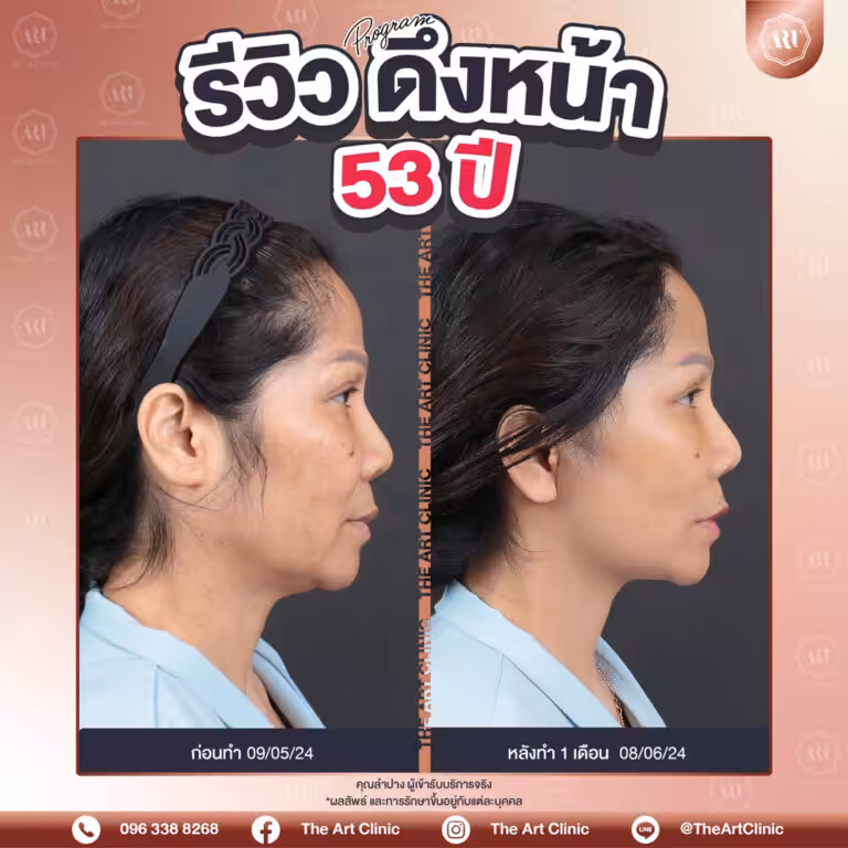 รีวิวดึงหน้า-Face-Lift-7