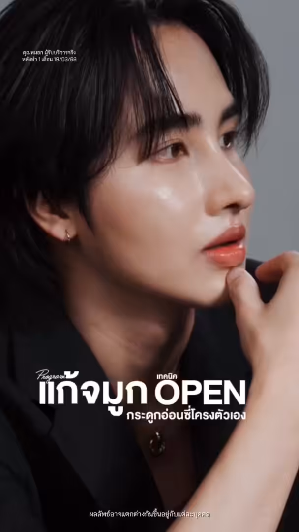 วิดีโอรีวิวความประทับใจหลังเสริมจมูก ที่ โรงพยาบาลศัลยกรรมดิอาท