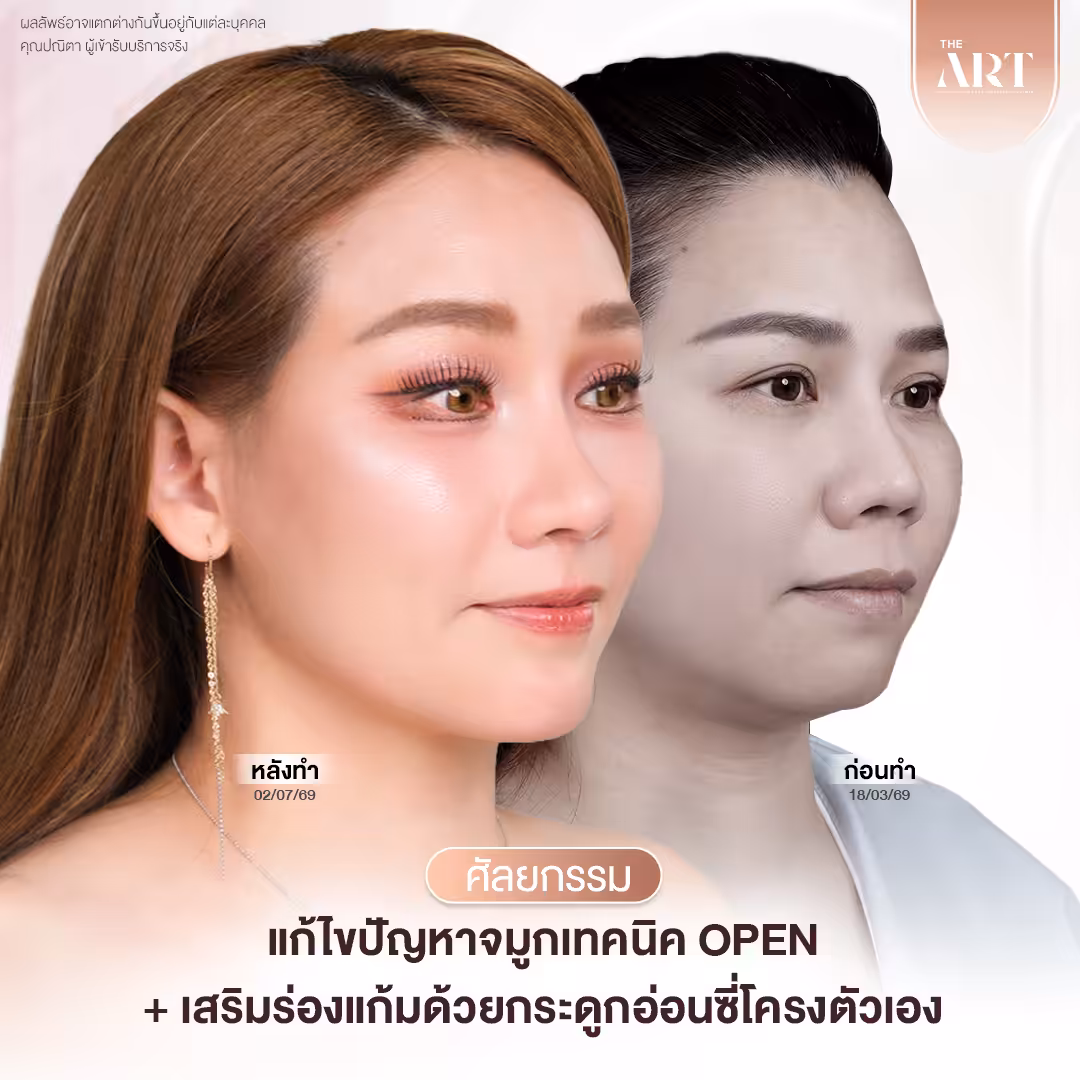 แม่นุ้ย Surgery Wars