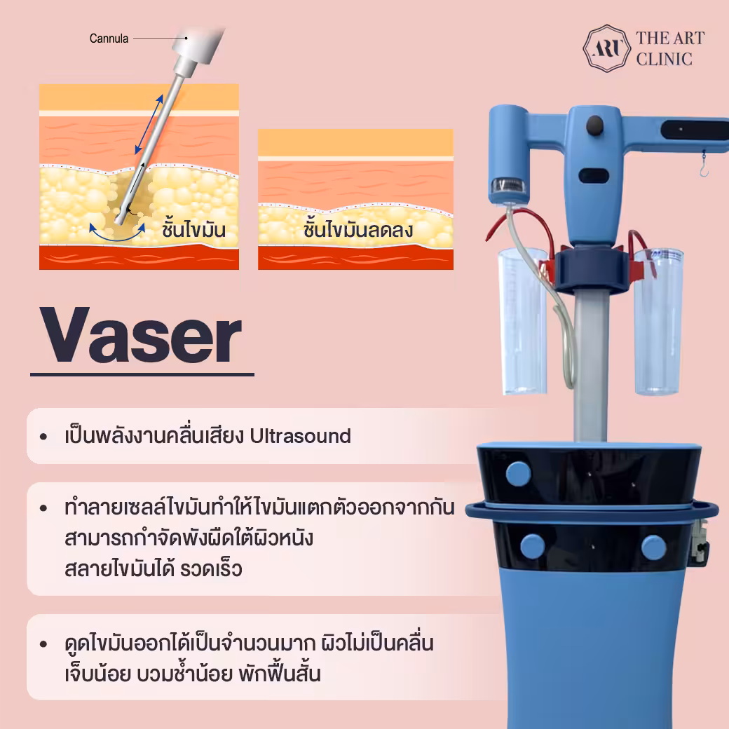 Info 3 นวัตกรรม ดูดไขมันที่ The Art Clinic_1040x1040 2
