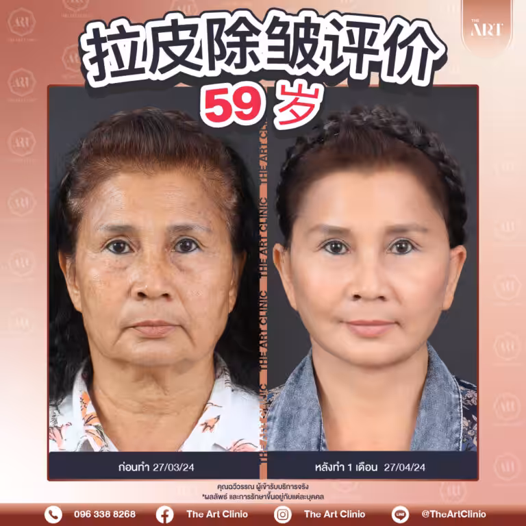 25-100