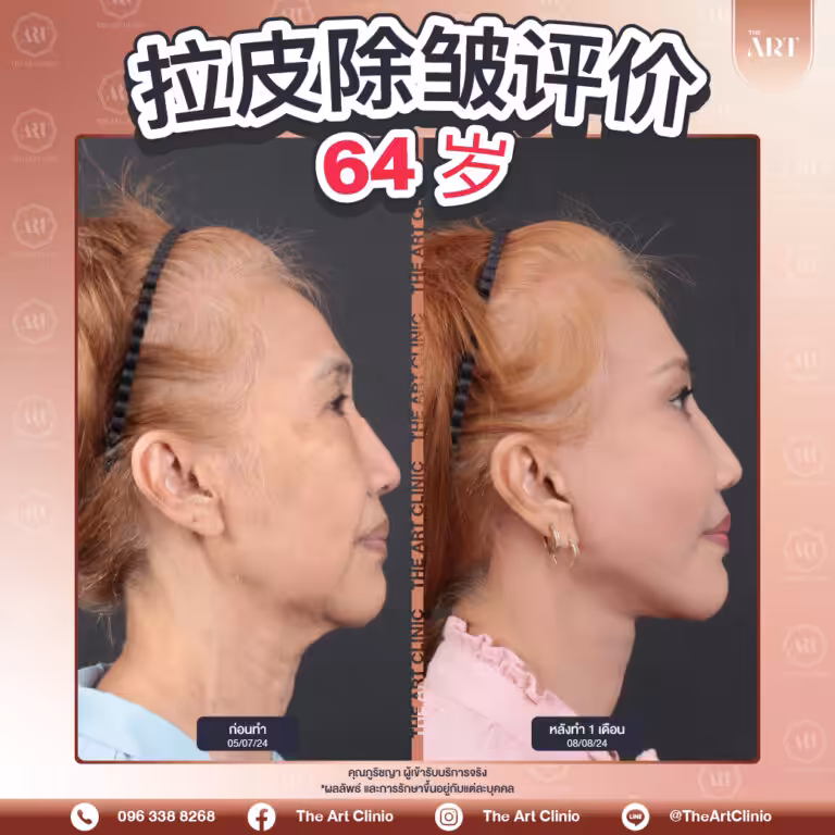 64-100