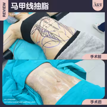 抽腹部脂肪 + 马甲线